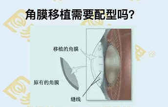 角膜移植需要配型嗎？